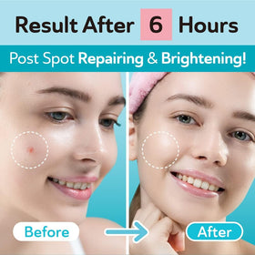 DERMA ANGEL absorption demo showing hydrocolloid drawing fluid away from blemish