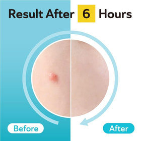 DERMA ANGEL opened packet with 96 patches arranged showing quantity convenience benefit