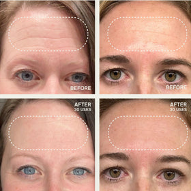 Dermaclara patch applied on model forehead demonstrating smoothing benefit