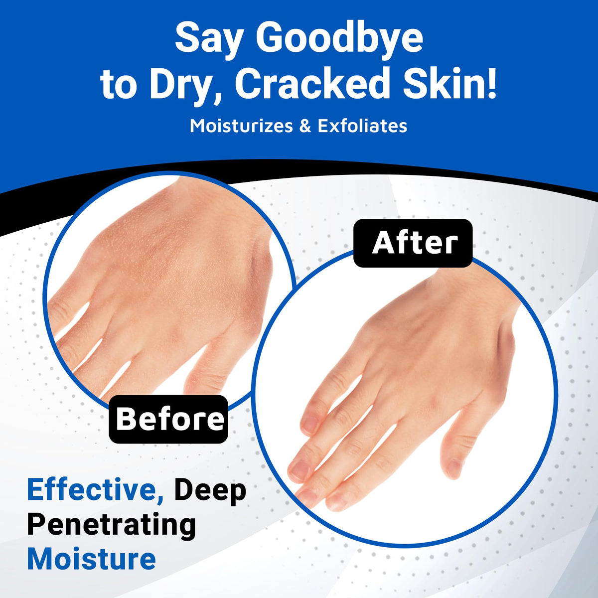 Dermal Therapy being applied to elbow to smooth rough skin effectively