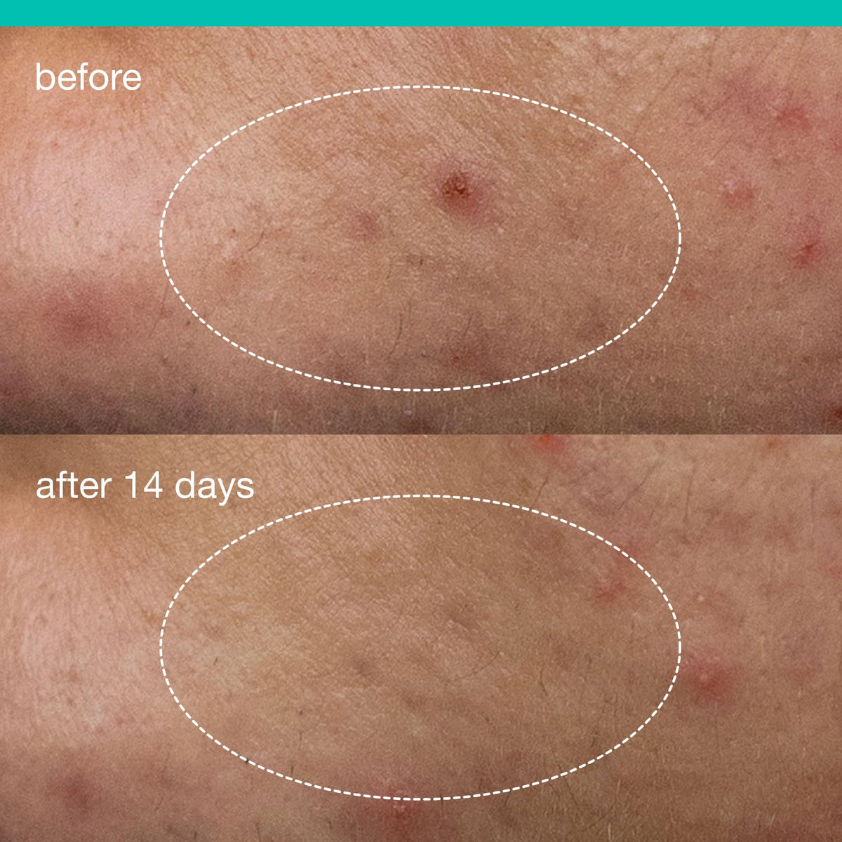 Dermalogica liquid dispensed on fingertip, shows easy precise application benefit