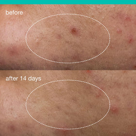 Dermalogica liquid dispensed on fingertip, shows easy precise application benefit