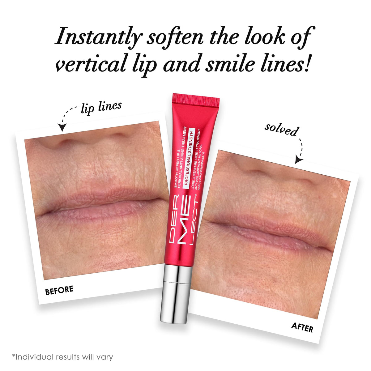 Dermelect ceramic applicator close-up for precise perioral placement
