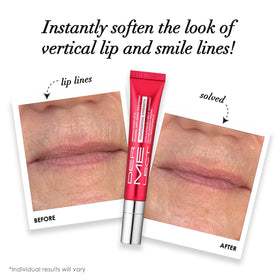 Dermelect ceramic applicator close-up for precise perioral placement
