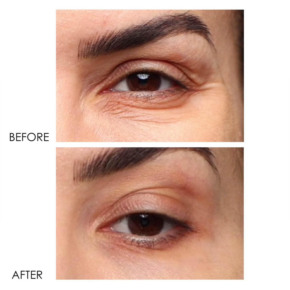Dermelect application demonstration reducing under-eye puffiness and lines