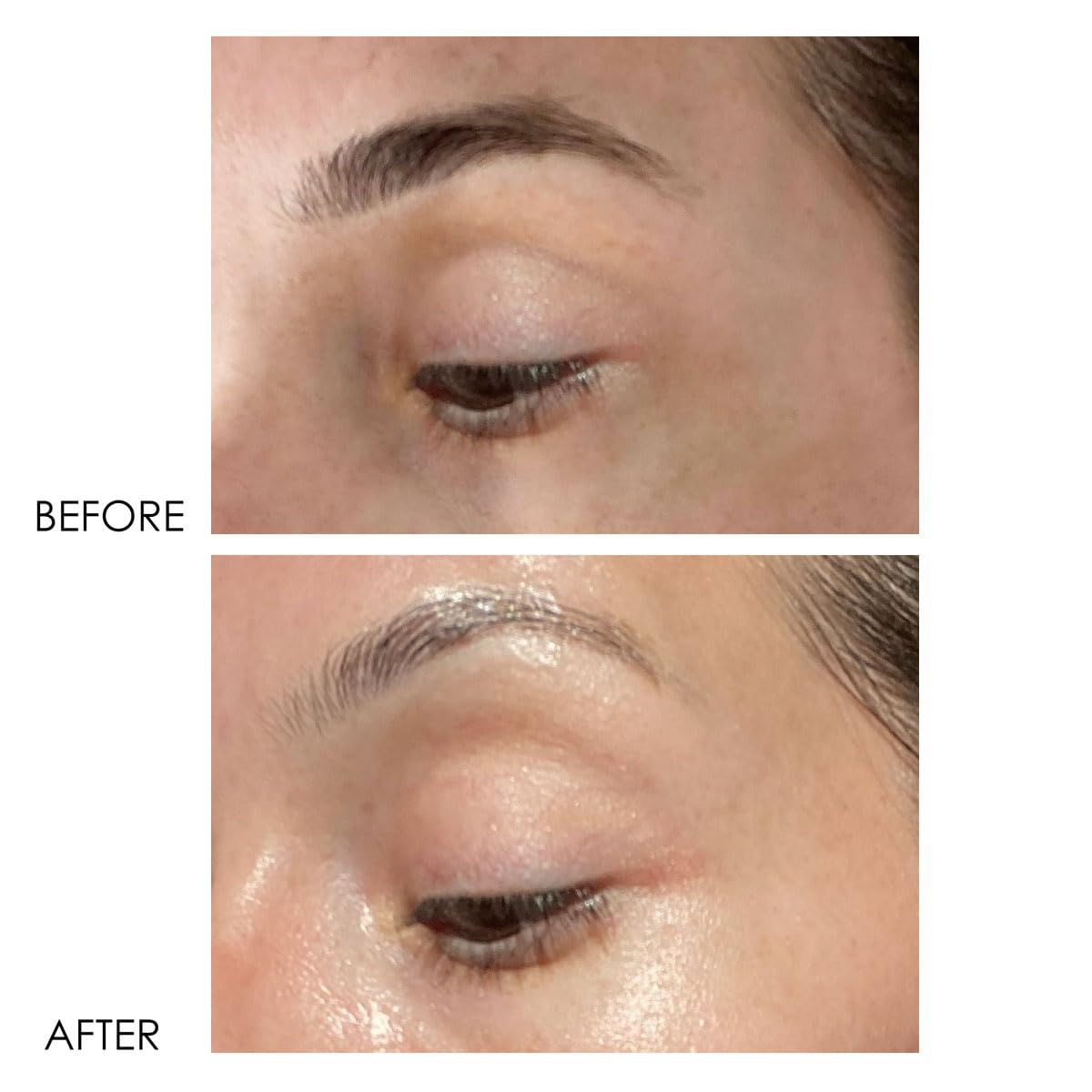 Dermelect before and after under-eye comparison showing visible improvement