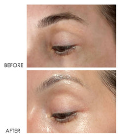 Dermelect before and after under-eye comparison showing visible improvement