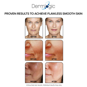 Dermlogic pre-soaked pad demonstrating even acid delivery benefit