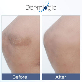 Dermlogic cream being applied under-eye to reduce puffiness and dark circles