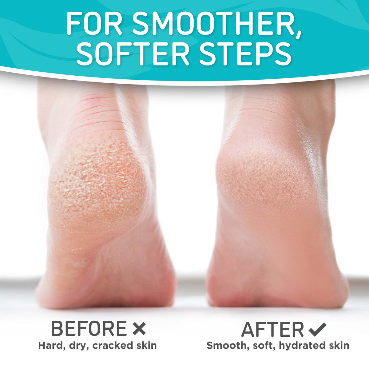 Dermora peeling stage showing flaking skin and renewed smoother soles