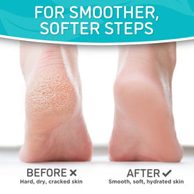 Dermora peeling stage showing flaking skin and renewed smoother soles