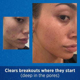 Differin before and after style illustration suggesting improved skin texture over time