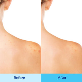 Differin back label highlighting ingredients and directions for confident use