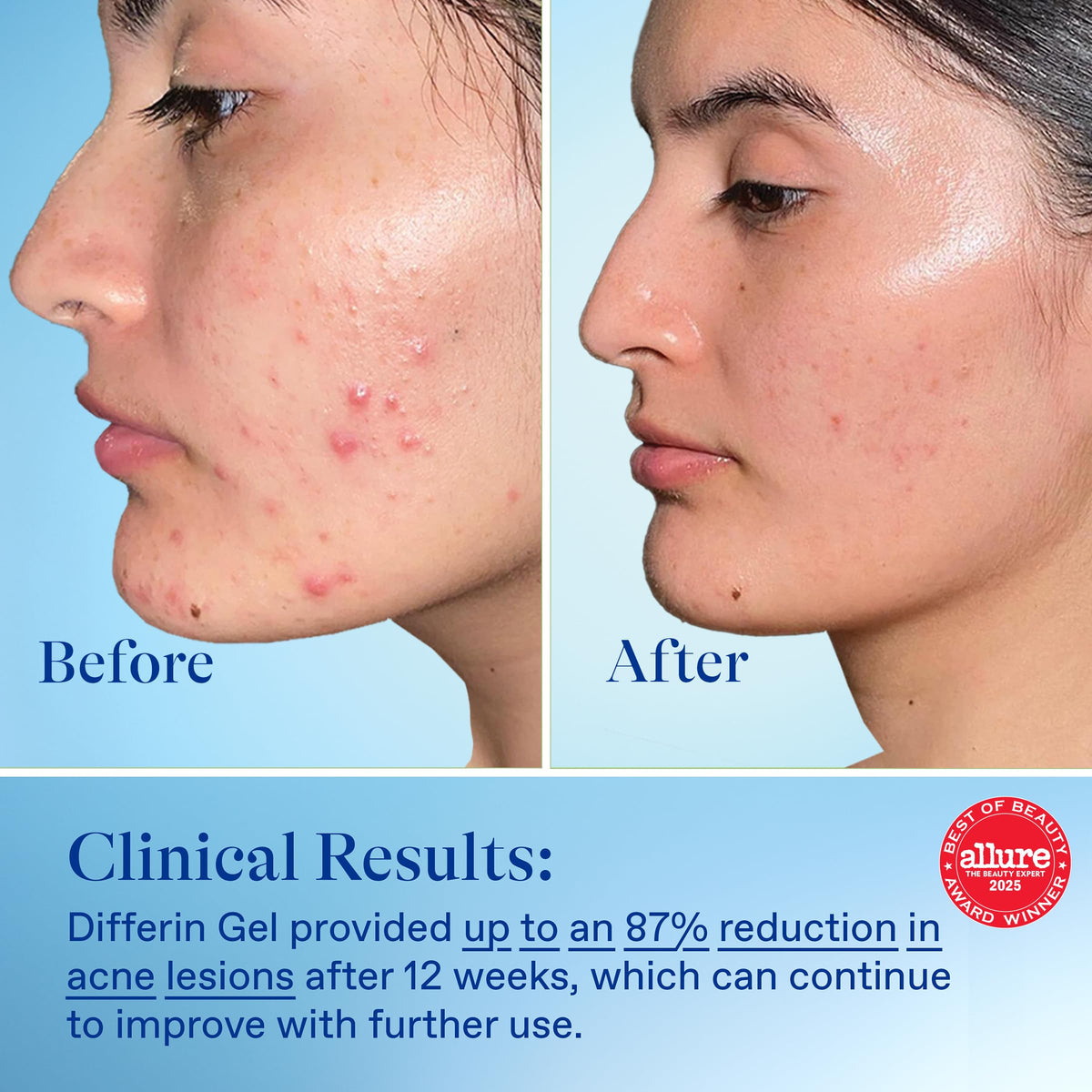 Graphic highlighting adapalene ingredient and pore-penetrating benefit from Differin