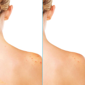 Differin placed in a gym bag representing post-workout acne care convenience