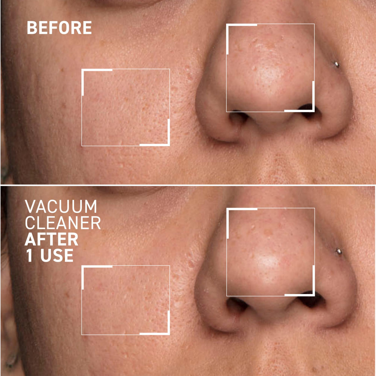 Dr. Brandt mask applied to nose area demonstrating pore-targeting benefit