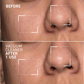 Dr. Brandt mask applied to nose area demonstrating pore-targeting benefit