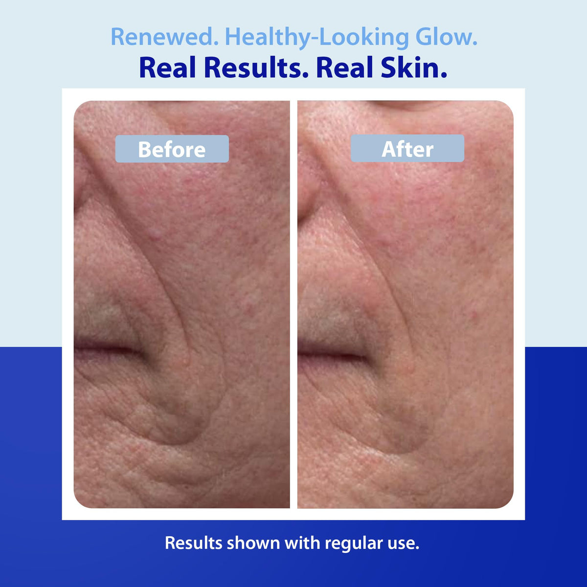 Dr. Denese peeling mask off to reveal clearer, refined skin underneath