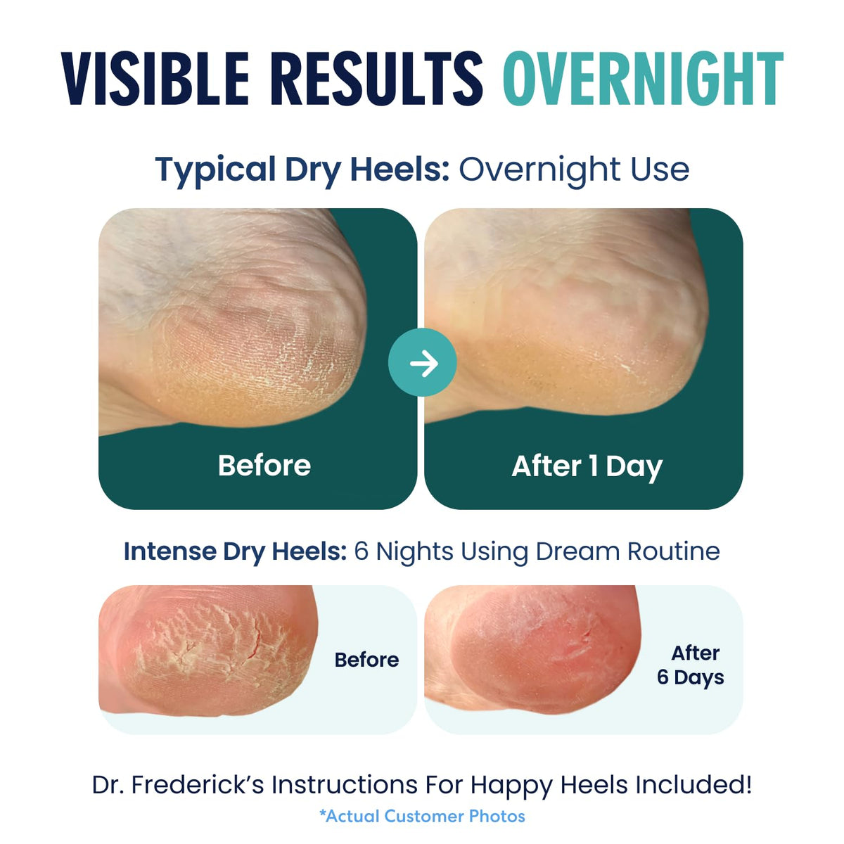 Dr. Frederick's socks worn in bed demonstrating overnight hydration benefit