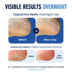 Dr. Frederick's socks worn at night showing hands-free overnight hydration