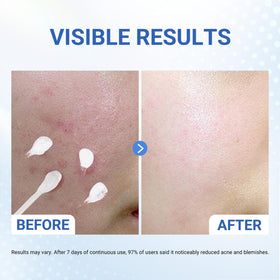 Dr.Leo ingredient label focused on 1.8% salicylic acid benefit: high-strength formula