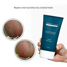 DRMTLGY being applied to heel to moisturize and soften cracked areas