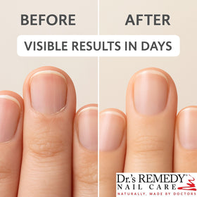 Applying Dr.'s Remedy oil to cuticle edge to hydrate and soften skin