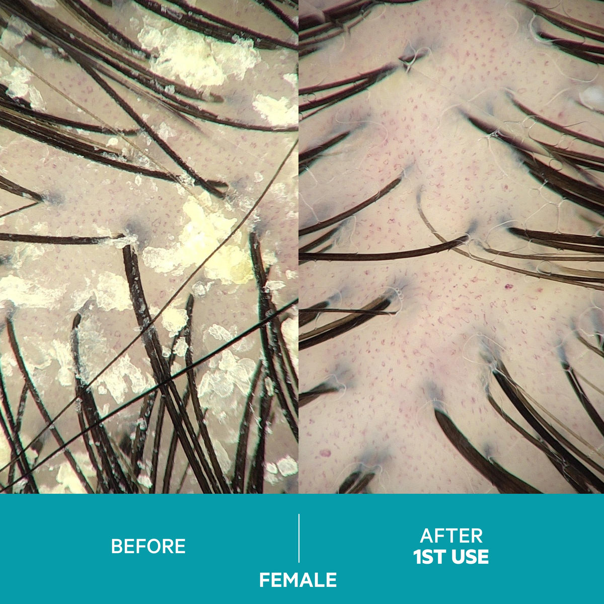 DS Laboratories before and after scalp images showing reduced flaking benefit