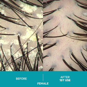 DS Laboratories before and after scalp images showing reduced flaking benefit
