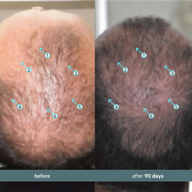 DS Laboratories applying serum to scalp demonstrating easy usage