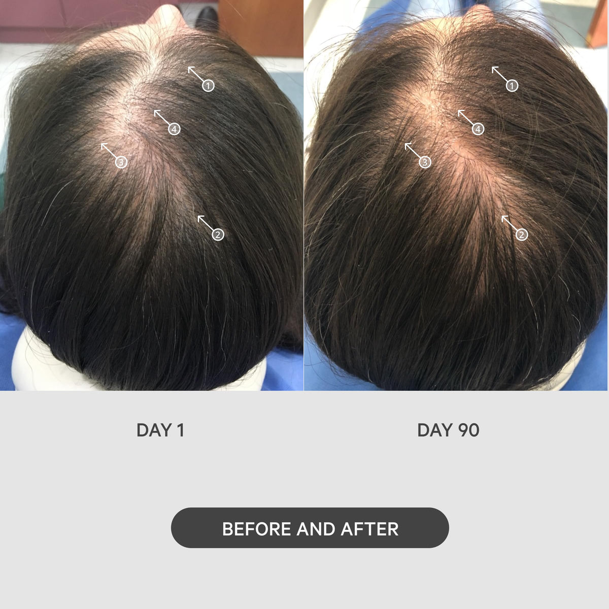 DS Laboratories StimuROLLER being rolled on scalp demonstrating application before serum