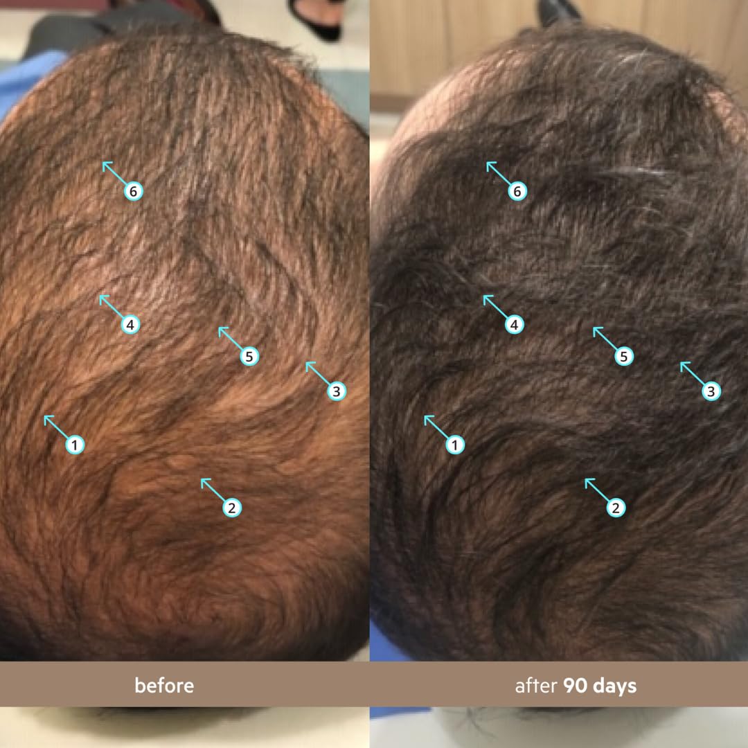 DS Laboratories scalp application on crown area, shows easy daily use for fuller look