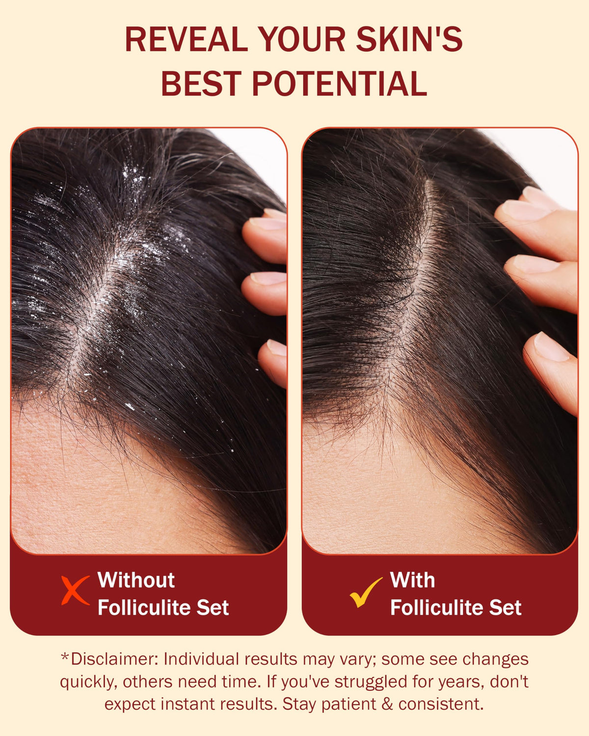 e70 tea tree oil bottle closeup underlining soothing, calming scalp benefit