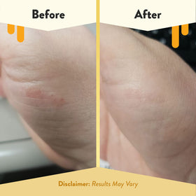 ECZEMA HONEY pad applied to forearm demonstrating itch relief and soothing