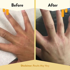 ECZEMA HONEY bottle in hand shows 8 oz convenience and portability