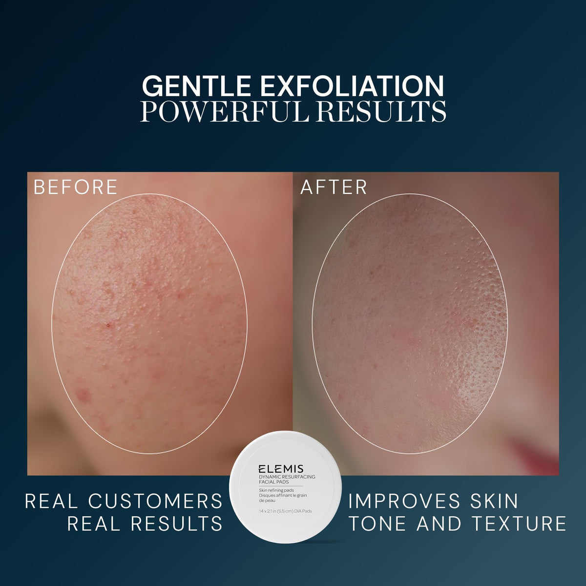 ELEMIS pad soaked with essence on fingers demonstrating controlled, no‑rinse application