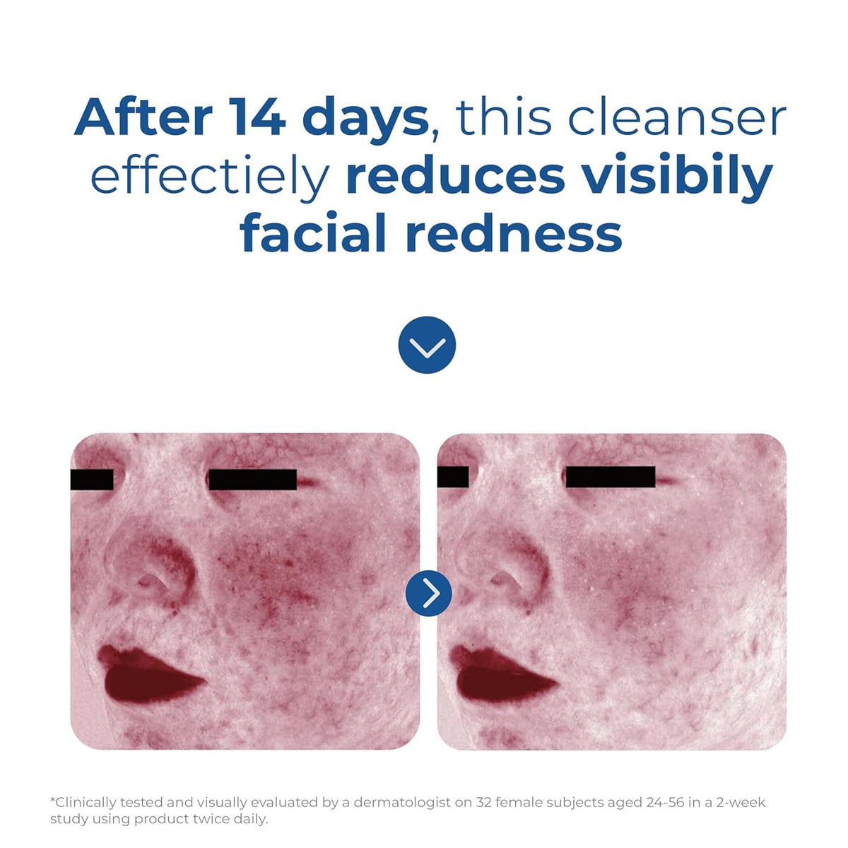 EltaMD bottle in dermatologist office setting suggesting approval for sensitive skin