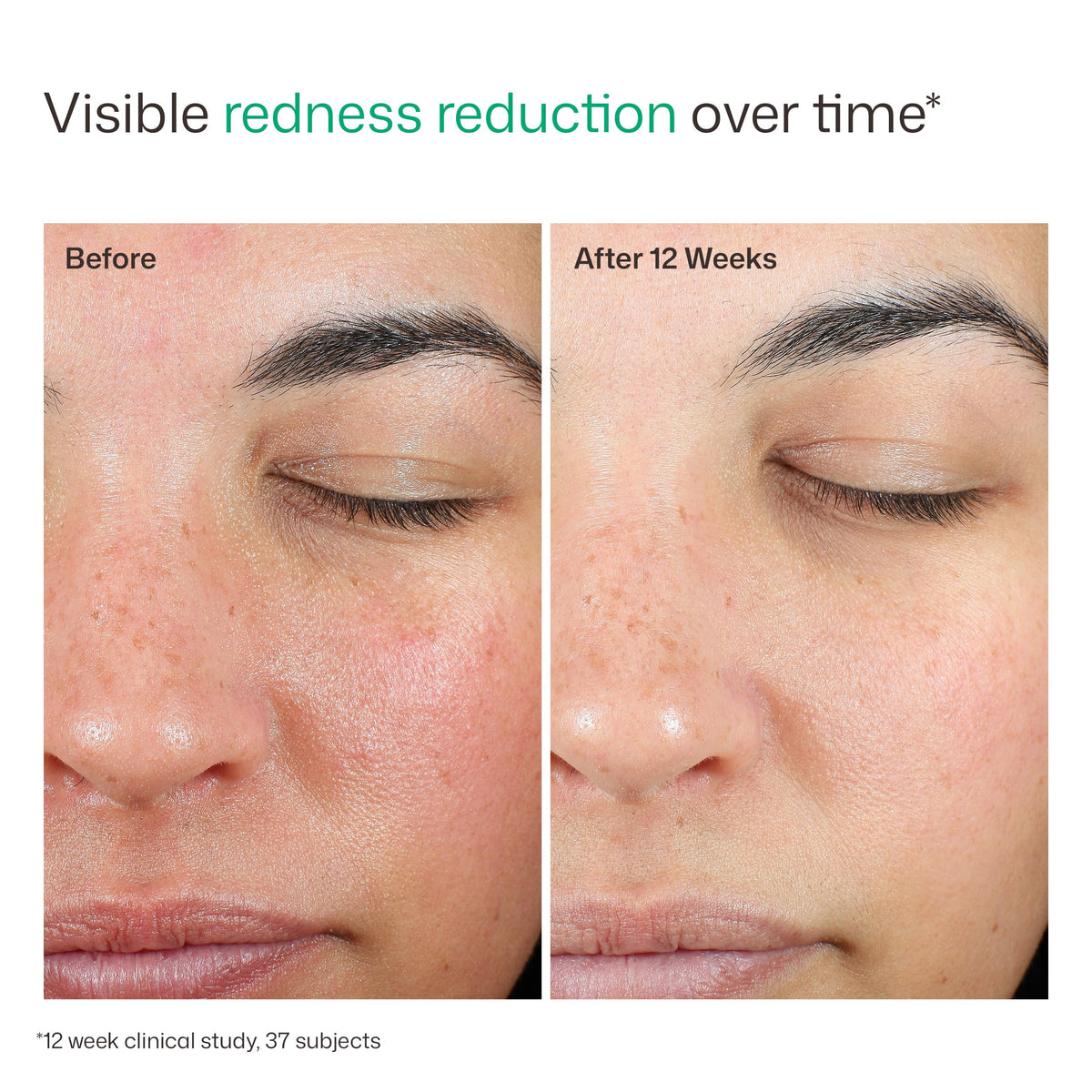 EltaMD applying sunscreen on face, brand helps even skin appearance