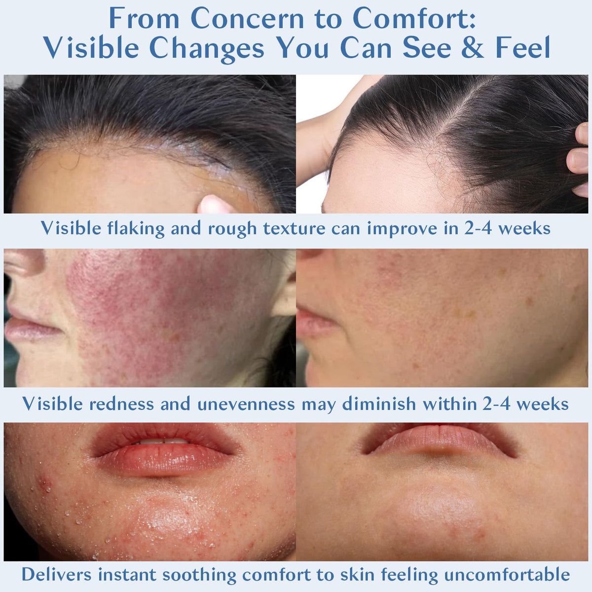 Eoiroa being smoothed into hairline to soothe scalp flaking effectively