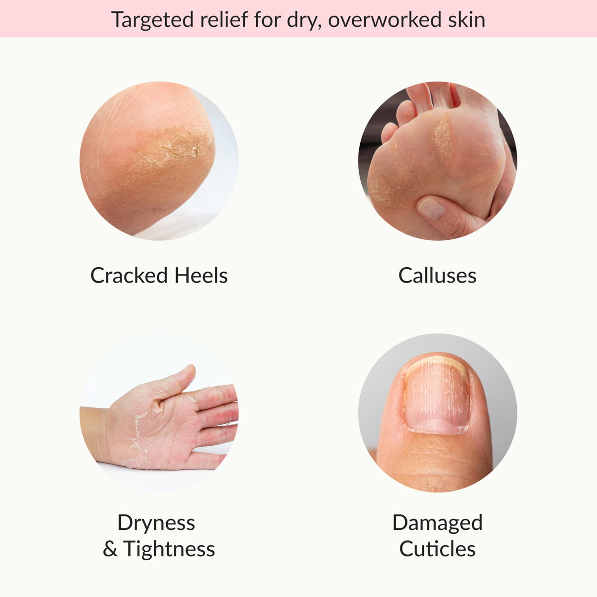 Person wearing Epielle glove during hand treatment for softening