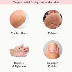 Person wearing Epielle glove during hand treatment for softening