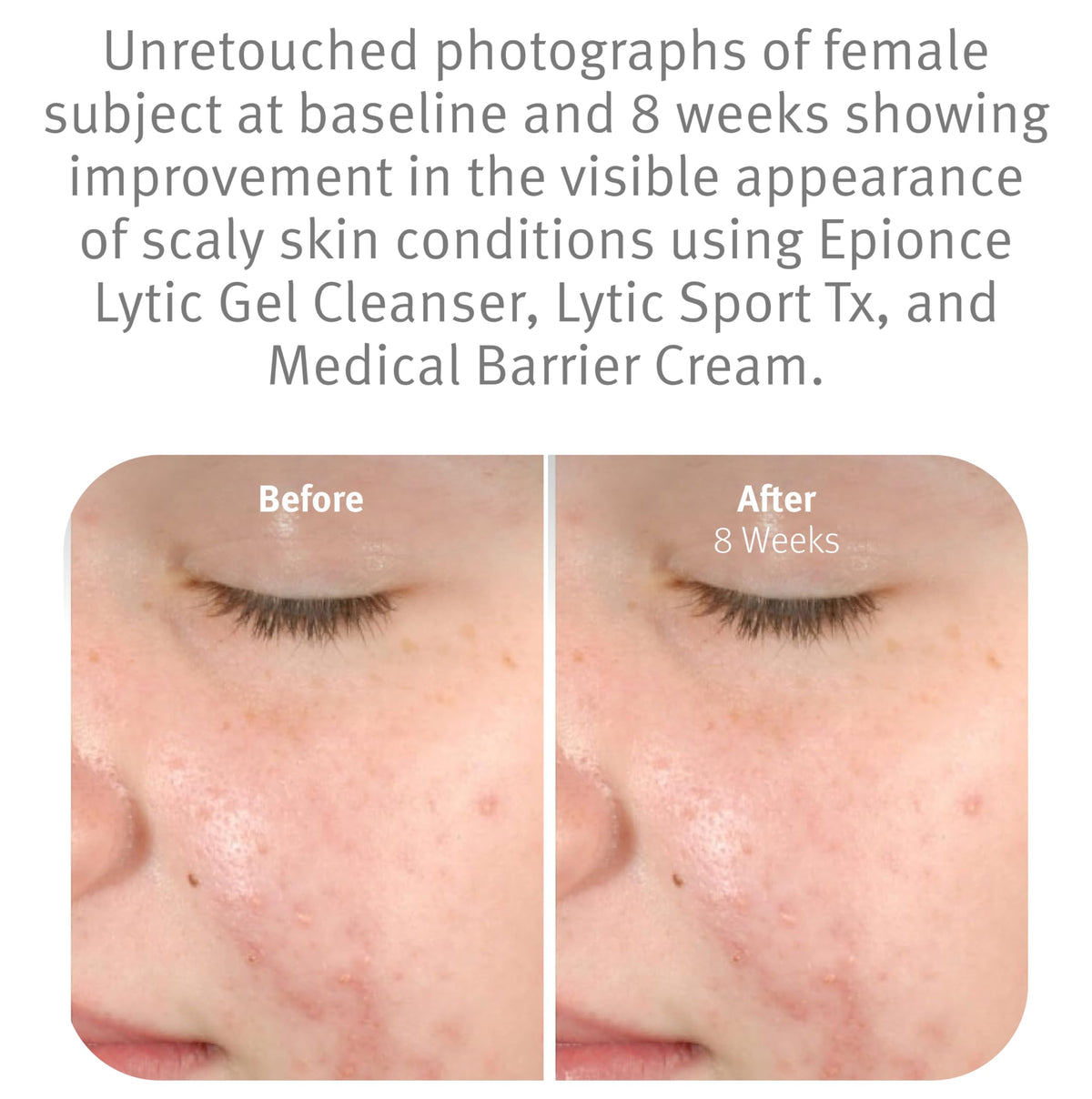 Epionce lytic gel cleanser willow bark ingredient focus for oil control