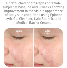 Epionce lytic gel cleanser willow bark ingredient focus for oil control