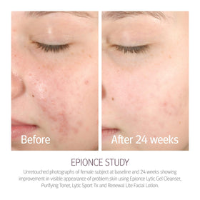 Epionce willow bark extract close-up highlighting natural exfoliant