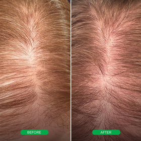 Everist EverBoost applied to scalp by hand showing targeted use and easy application