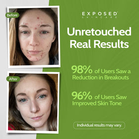 Exposed Skin Care benzoyl peroxide treatment detail showing targeted blemish control