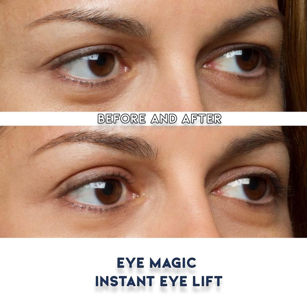 Eye Magic before and after photo showing visible eyelid lift effect