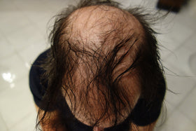 Finally Hair before and after part line comparison showing improved density and confidence