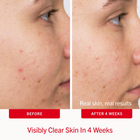 First Aid Beauty pad being applied to cheek demonstrating gentle, targeted treatment