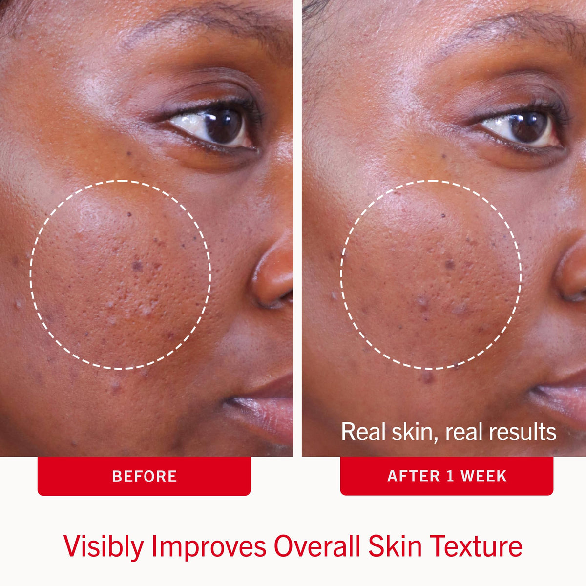 First Aid Beauty visual of salicylic acid concept emphasizing acne-fighting benefit